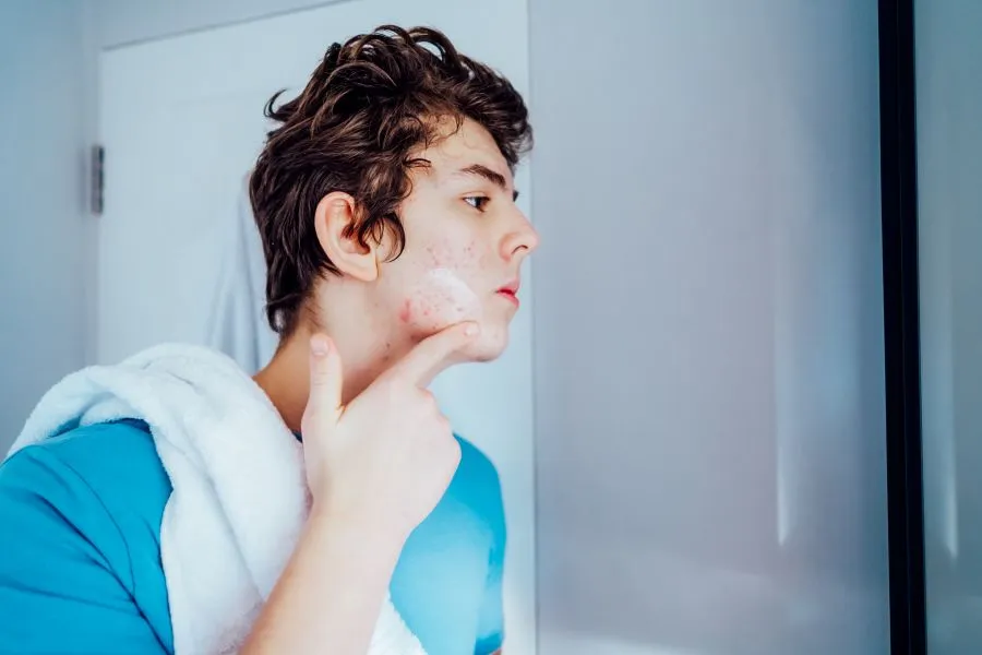 A teenage boy with acne putting cream on his face.
